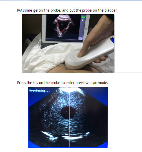 4D Wireless Bladder Scanner Wireless Ultrasound Transducer &probe
