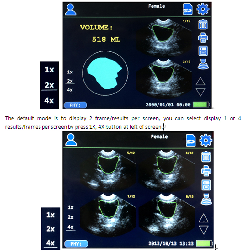 wholesale discount Ultrasound Bladder Scanner