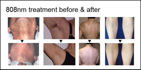 Best skin painless hair removal MSLDL05