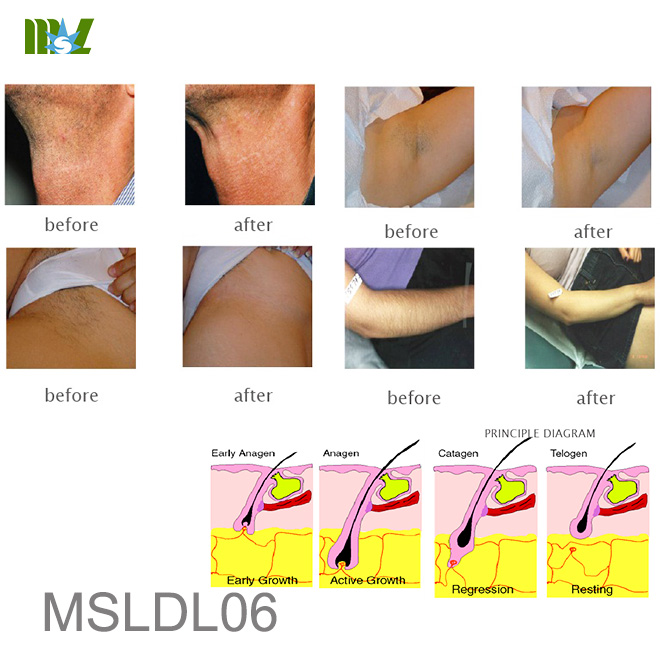 eliminación de vello encarnado MSLDL06