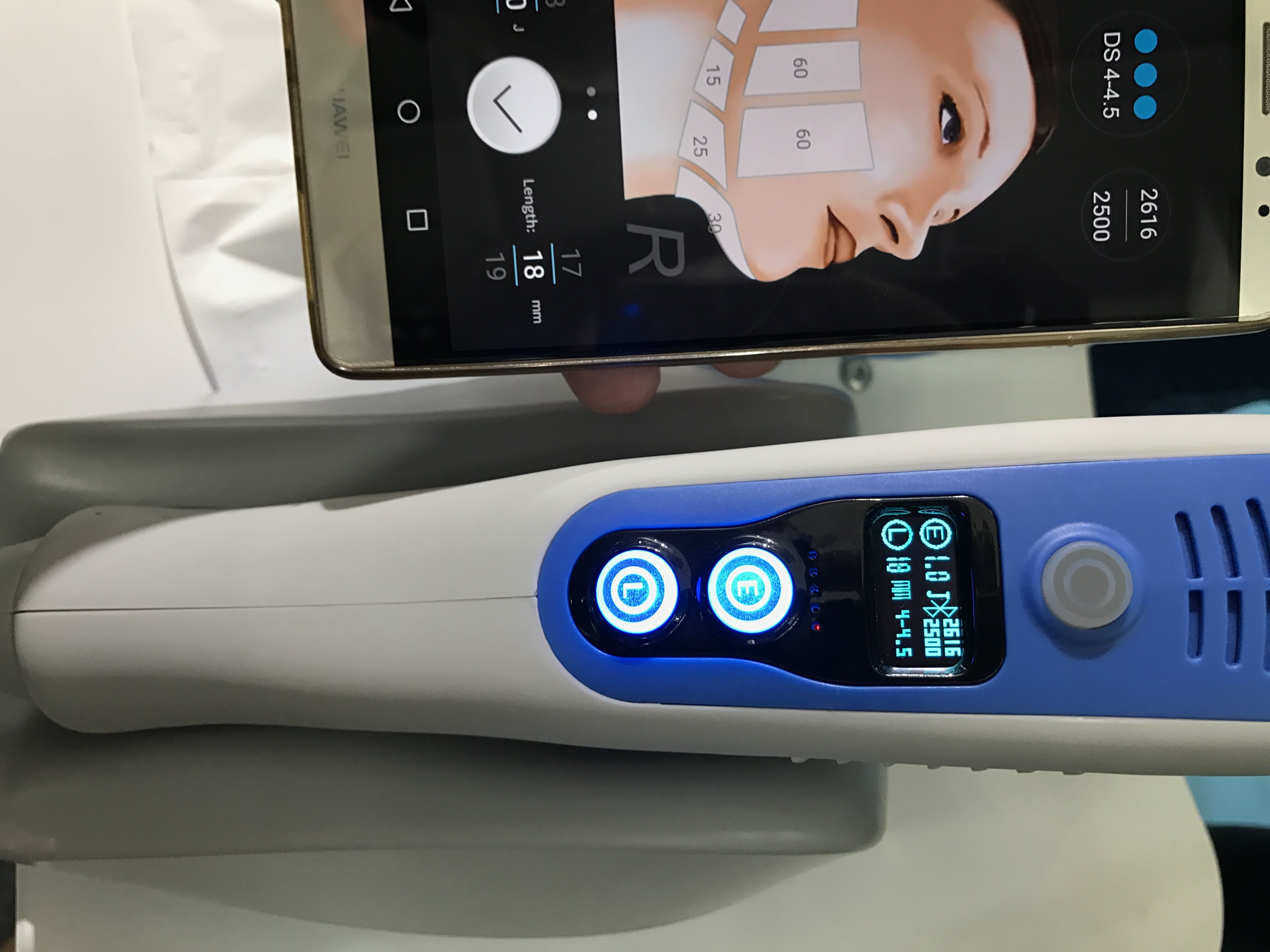 Mini lifting facial hifu