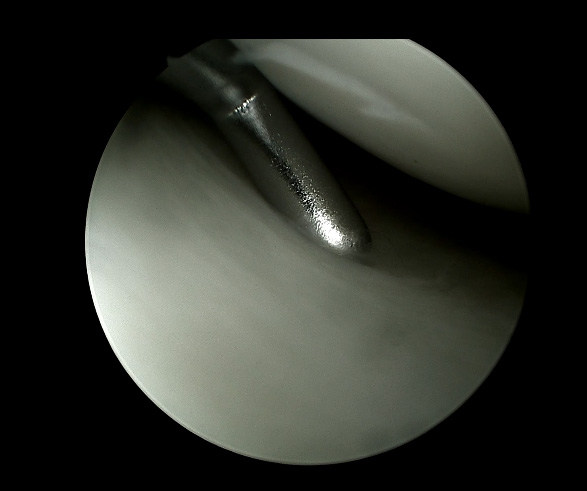 endoscopio rígido HD