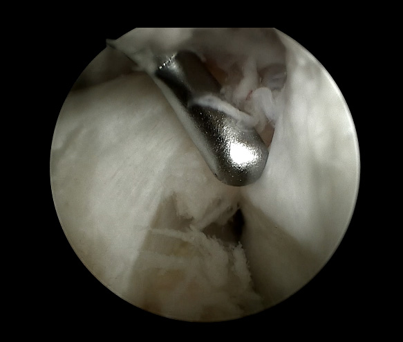 endoscopio de video HD