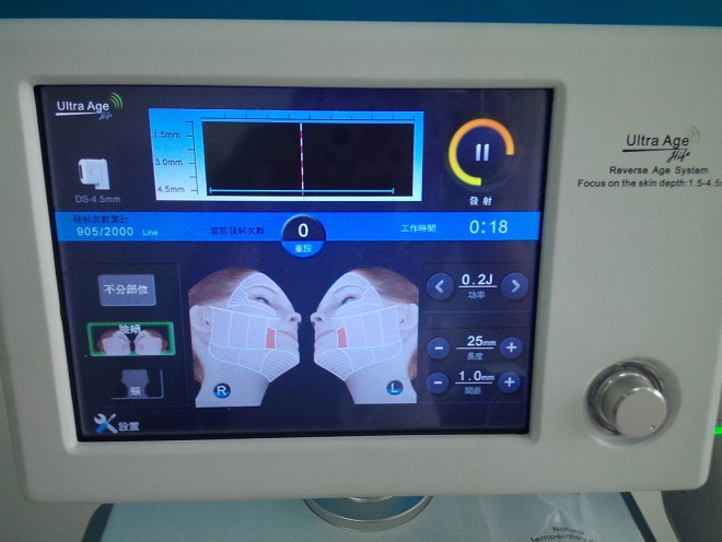 terapia hifu