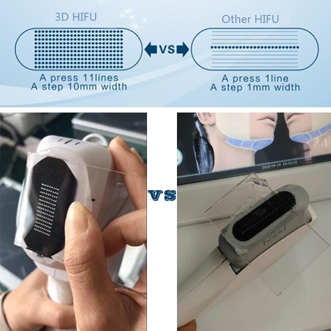 hifu antes y después