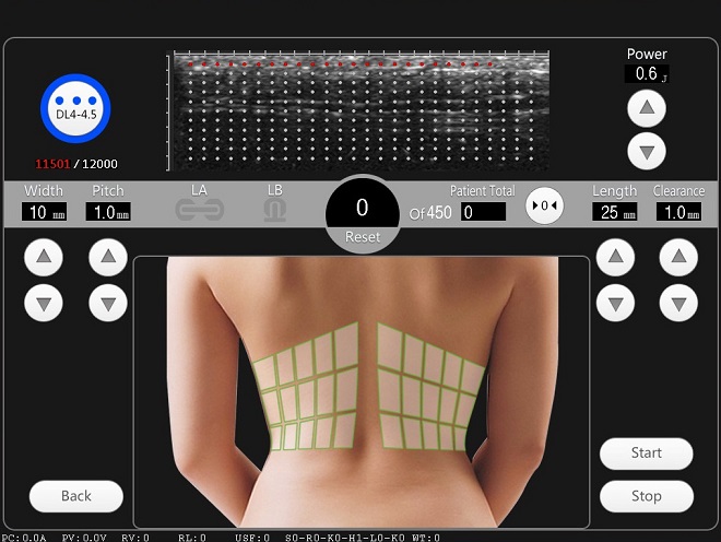 terapia hifu para el rostro