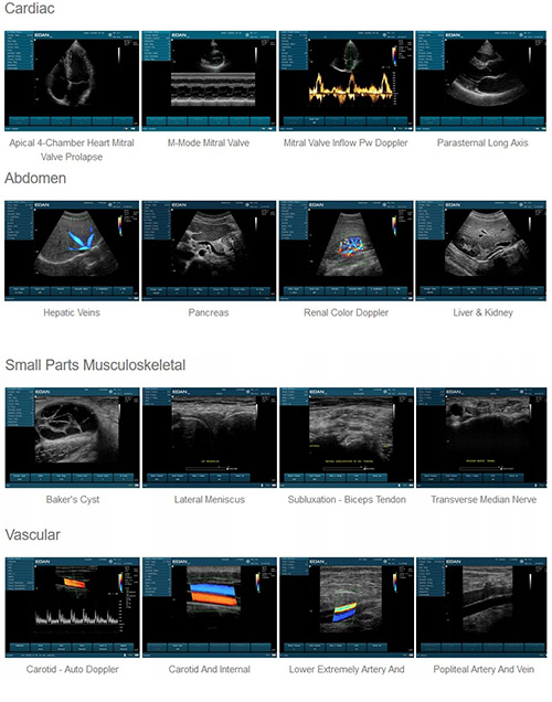 EDAN U2 portable ultrasound machine